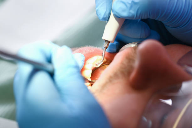 Best Emergency Treatment for Dental Infections or Abscesses in Jasper, AL