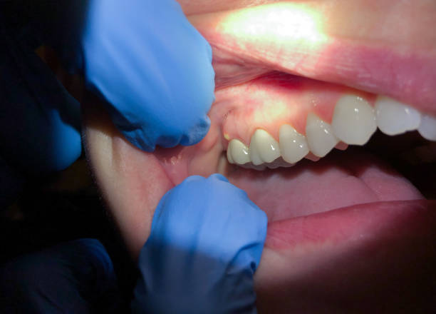Best Emergency Gum Treatment in Jasper, AL
